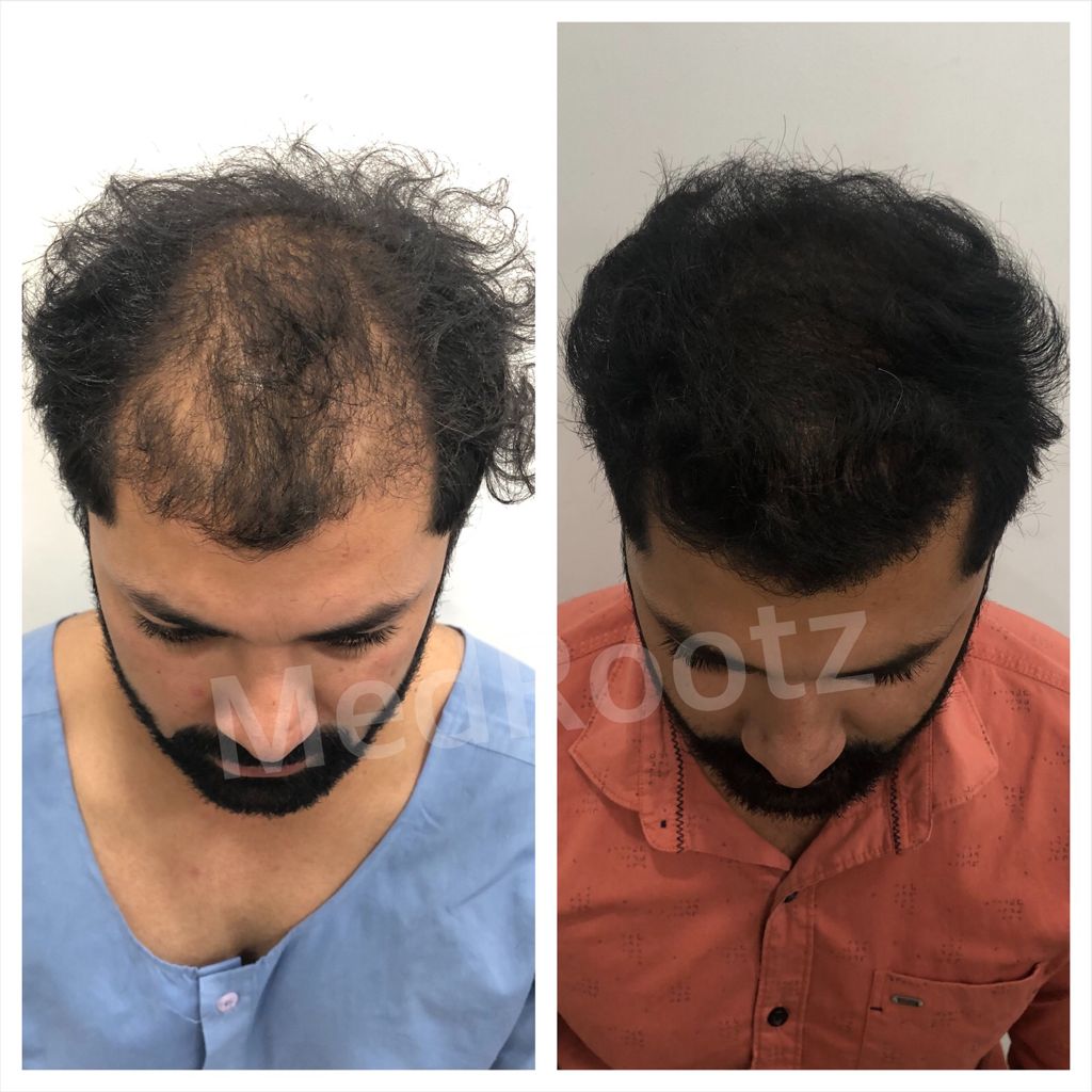 Best Hair Transplant clinic in delhi